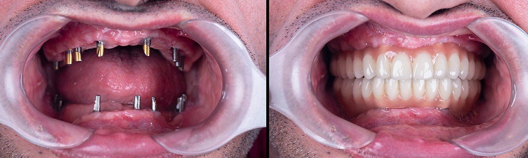 Full Mouth Reconstruction London