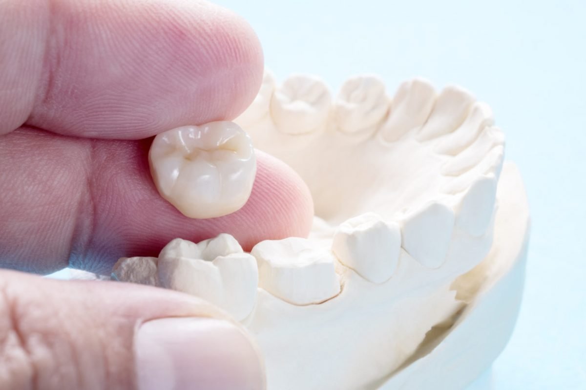 Dental Crown
