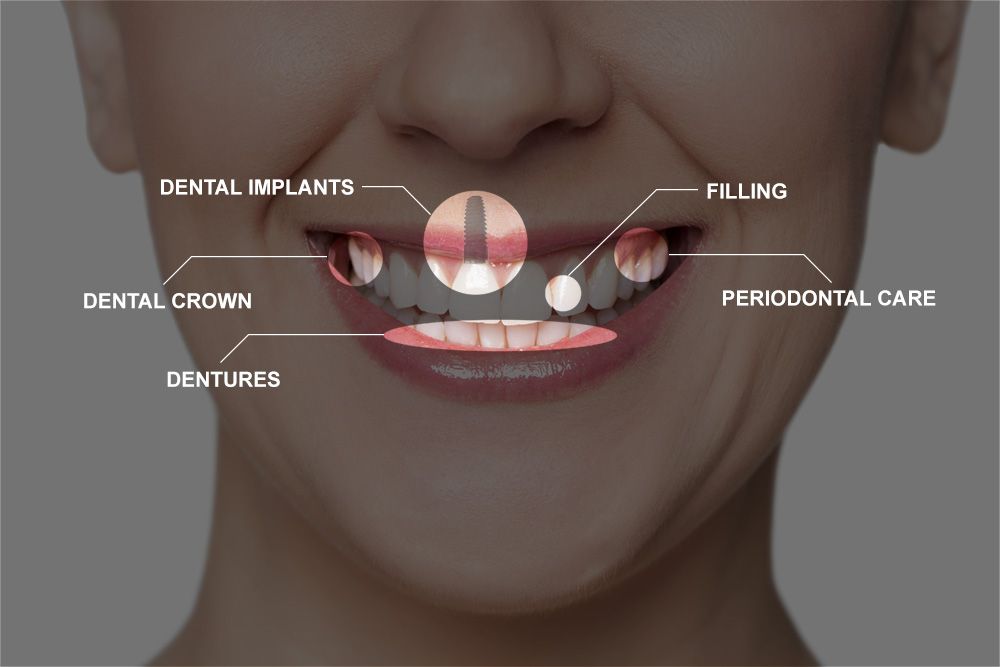 Full Mouth Reconstruction